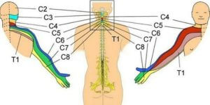 Cervical Radiculopathy 