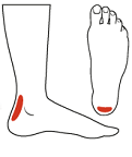 Achilles Tendonitis in Toronto