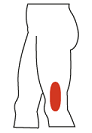 Iliotibial Band Syndrome in Toronto
