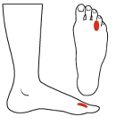 Morton's Neuroma in Toronto