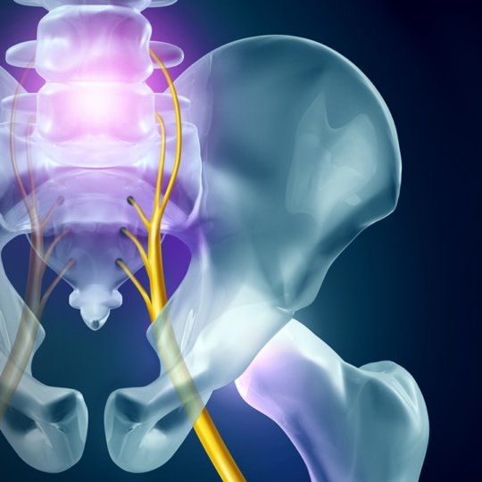 Sciatica