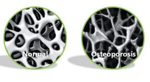 osteoporosis