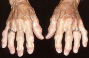 hand osteoarthritis