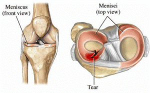 meniscal knee injury