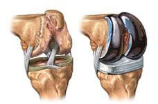 total knee replacements