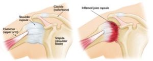 frozen shoulder