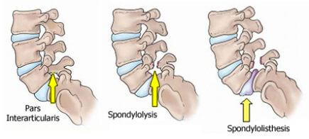 Spondylolisthesis