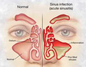 naturopathy for chronic sinusitis