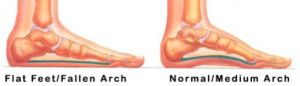 Flat Feet or Fallen Arch