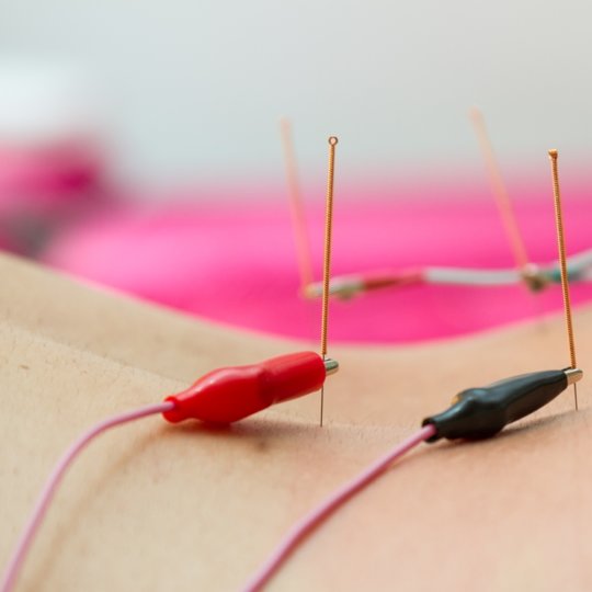 What is Electro-Acupuncture and is it the right treatment modality for you?