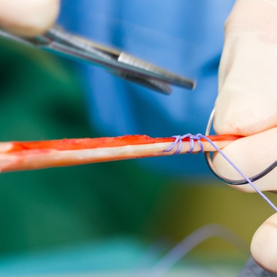Patella vs Hamstring ACL Reconstruction Graft Options