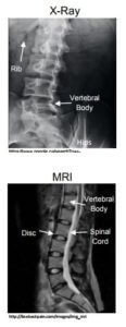 x-ray and mri