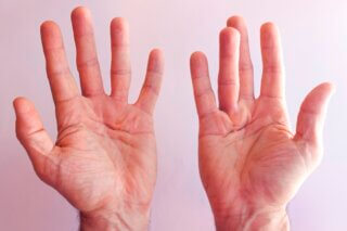 Duputrens Contracture