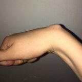 Ganglion Cyst