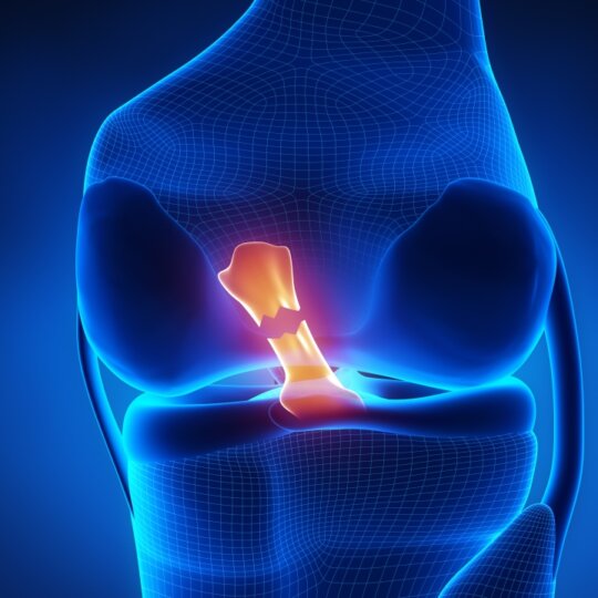 ACL Tears: Causes, Symptoms, Treatment and Exercises