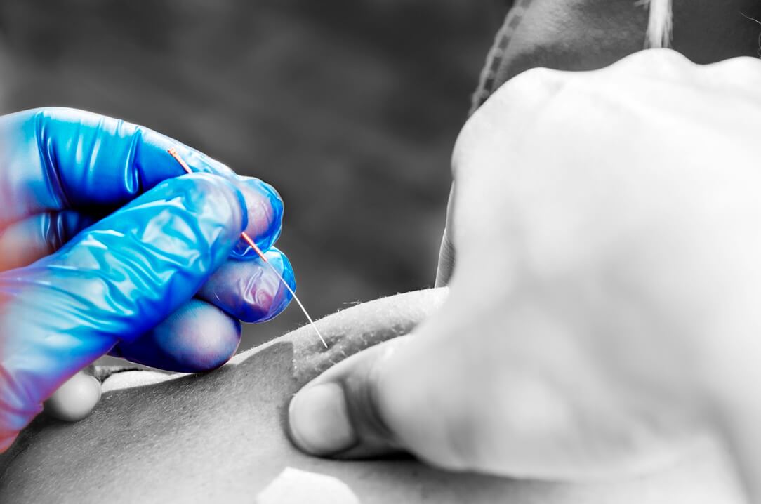 dry-needling-in-toronto.jpg