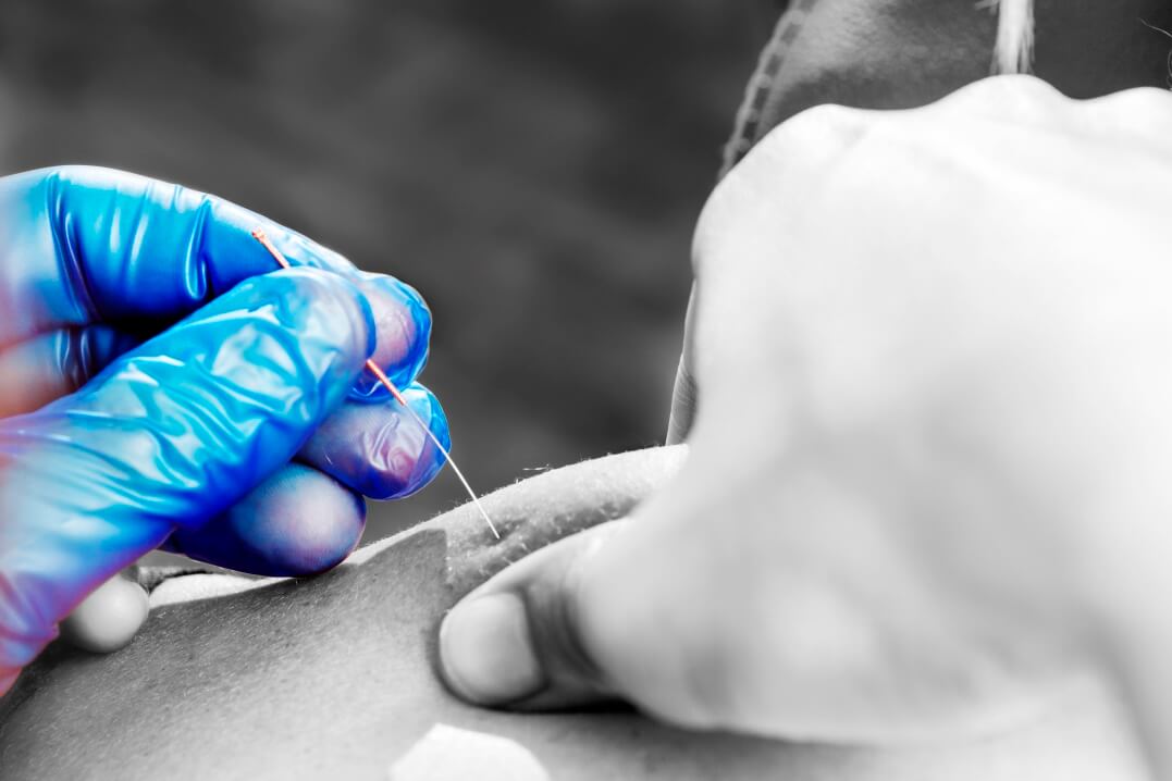 Acupuncture-Dry-Needling-and-Gunn-IMS-in-downtown-Toronto.jpg