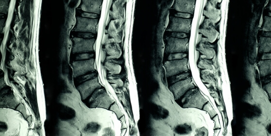 mri-scan-of-lumbar-spines.jpg